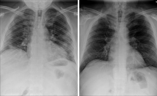 Imagen de rayos-X del tórax de una persona con Covid-19 y placa de un paciente que dio negativo en Covid-19